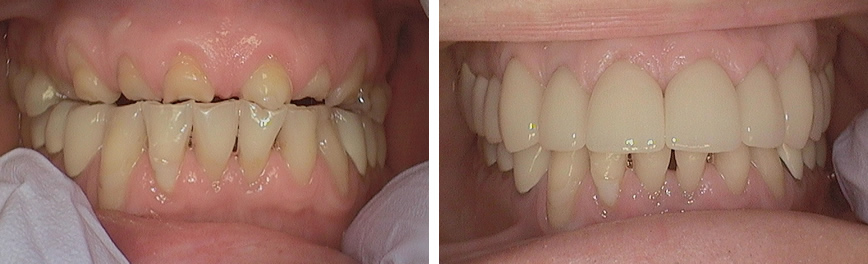 Porcelain Crowns