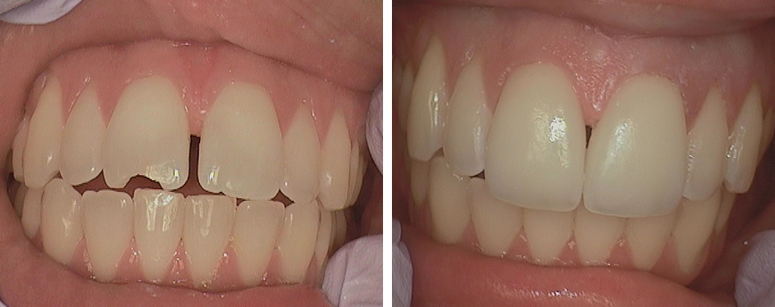 Porcelain Veneers